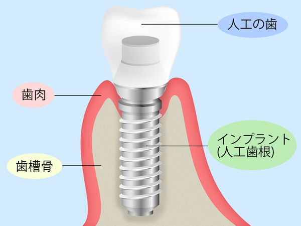 インプラント治療とは？