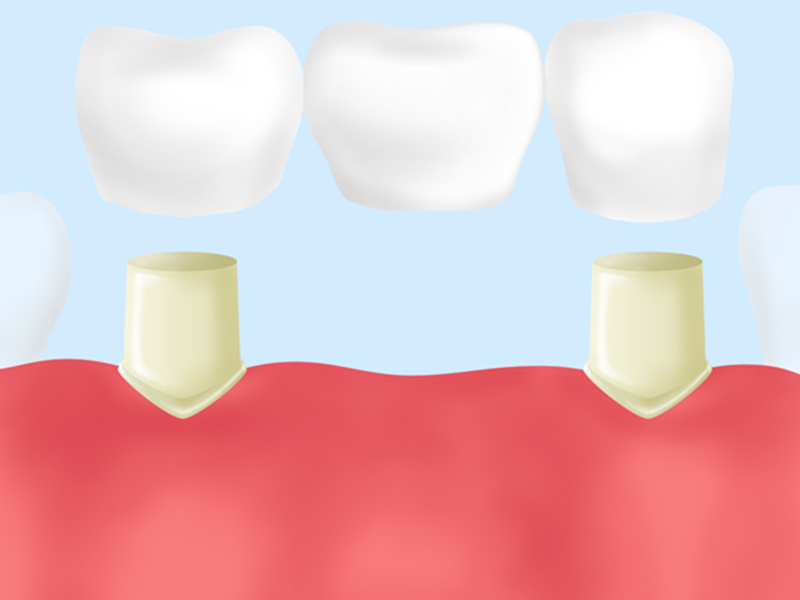 ブリッジ治療