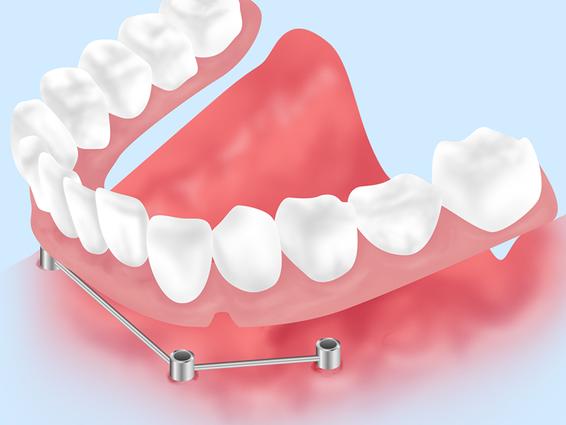 インプラントオーバーデンチャー（自費診療）