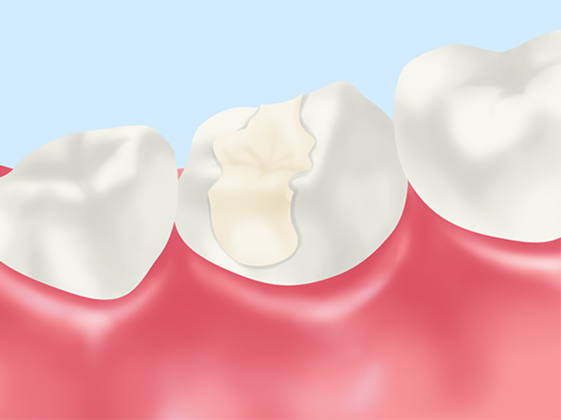 レジン（保険適用の詰め物）