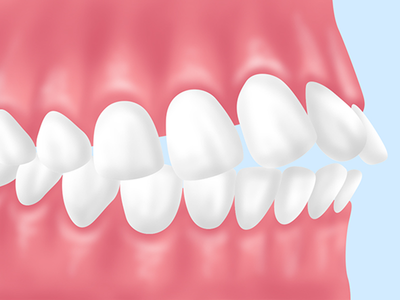 上顎前突（じょうがくぜんとつ）