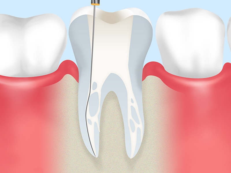 根管治療