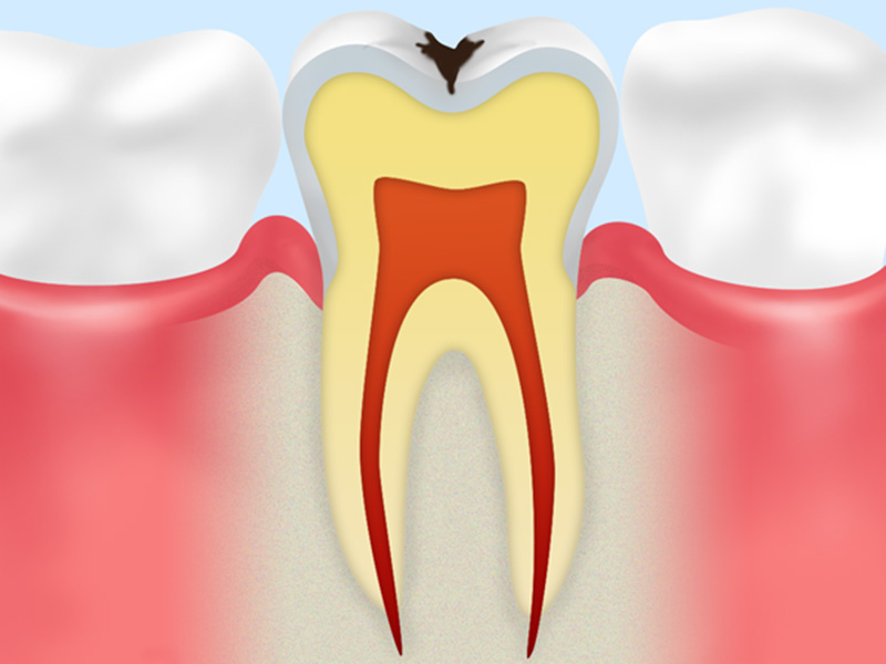 C1:エナメル質の虫歯