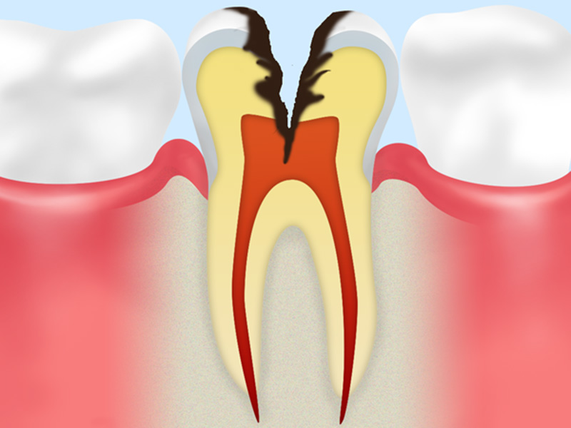 C3:神経にまで達した虫歯