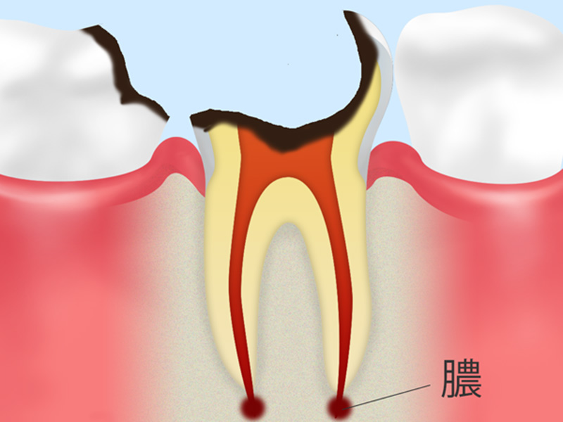 C4:歯根に達した虫歯